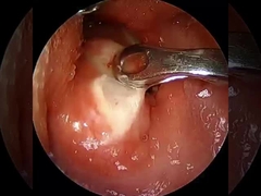 Courant ≤ 1,5 mA Arthroscopie RF Plasma Wand Équipement chirurgical Épaule Hanche Genou