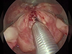4 canaux ENT Instruments chirurgicaux avec électrode active à triple fil standard